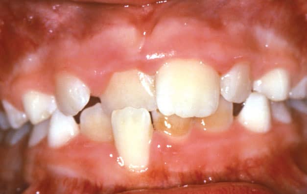 Crossbite Problem Coastal Smiles Family Orthodontics in Naples, FL
