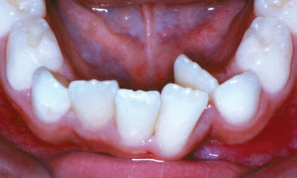Crowding Bite Problem Coastal Smiles Family Orthodontics in Naples, FL