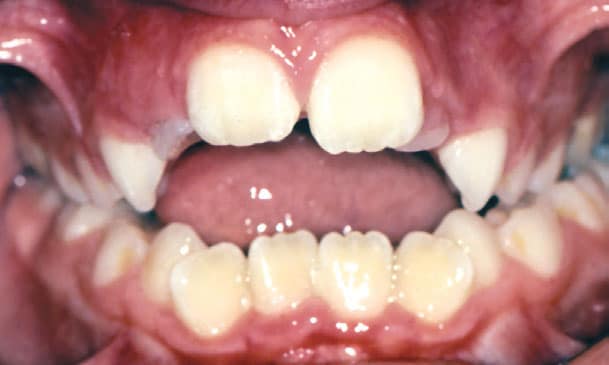 Open Bite Problem Coastal Smiles Family Orthodontics in Naples, FL