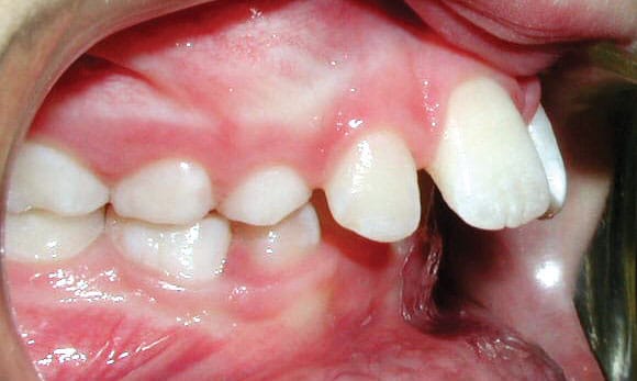 Protrusion Bite Problem Coastal Smiles Family Orthodontics in Naples, FL